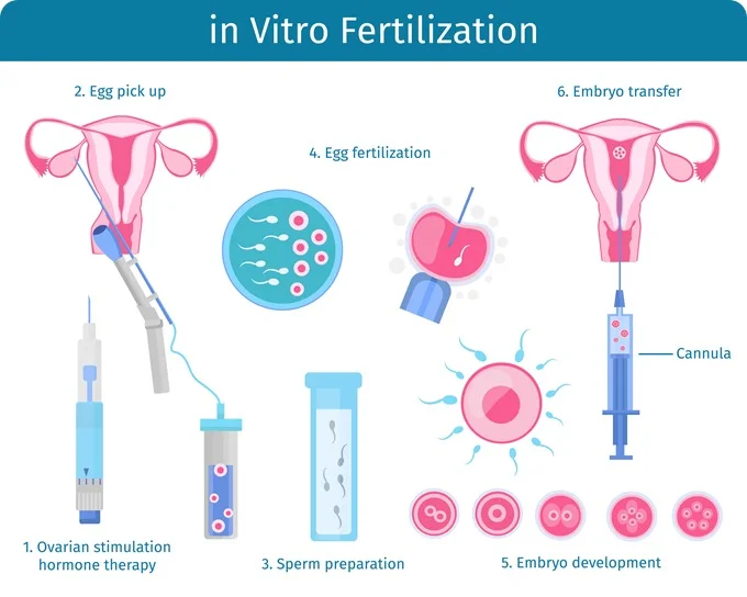 IVF (In Vitro Fertilization)